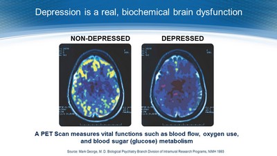 PET scan showing the physical differences between a depressed and a non-depressed brain