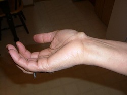 Ganglion cyst. By User:GEMalone (Own work) [GFDL (http://www.gnu.org/copyleft/fdl.html) or CC BY 3.0 (http://creativecommons.org/licenses/by/3.0)], via Wikimedia Commons