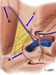 Hesselbach's triangle