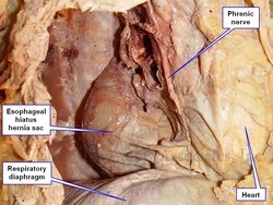 Type I esophageal hiatus hernia<em>.</em>The hernia sac can be seen posterior to the heart