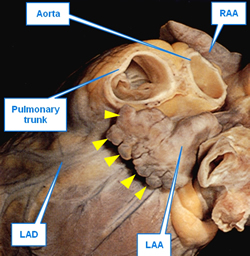 Left atrial appendage. Image modified from Gosling 1996 