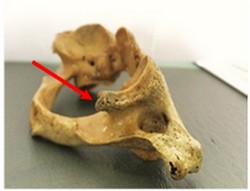 Figure A: Incomplete PP viewed from the posterior aspect of the articular fossa related to the retroglenoid tubercle.