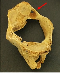 Figure B: Complete PP on a C1 sample. The PP crosses from the retroglenoid tubercle down to the posterior arch