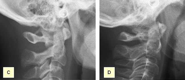Figure C: Complete PP shown on a lateral radiographic view. Figure D: Partial PP shown on a lateral radiographic view.