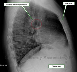 Lateral thoracic x-ray image showing the aortopulmonary window. Image courtesy of Prof. Uribe
