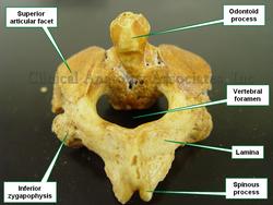 C2 - Axis. Posterosuperior view