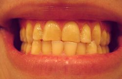 Bruxism teeth damage and misalignment