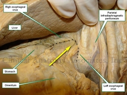 Esophageal hiatus hernia in situ.The arrow points to stomach and greater omentum herniating into the thorax