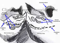 Fenestrations (Normal and abnormal) in the cusps of the aortic valve