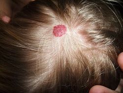 Small hemangioma on the scalp of a two year old