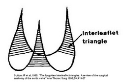 Interleaflet triangles of the aortic valve by Sutton