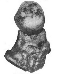 Lithopedion. Bainbridge, WS 1911