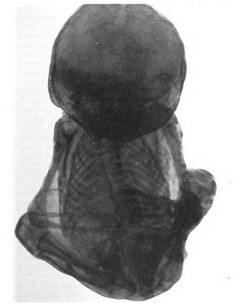 Lithopedion. Bainbridge, WS 1911