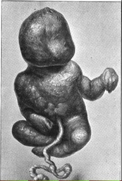 Lithopedion Clark,JG 1897