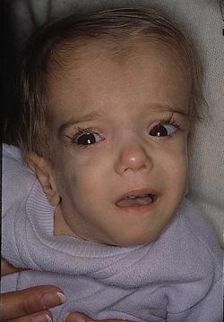 A patient with mevalonic aciduria at the age of 21 months displaying characteristic facial dysmorphism.