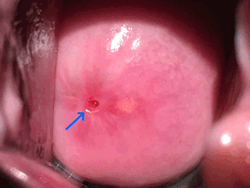 Uterine cervix with three Nabothian cysts