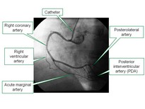 Right coronary artery angiogram