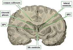 Double septum pellucidum and cavum septi pellucidi - SP=septum pellucidum