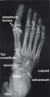 Foot X-ray. Sesamoid bones