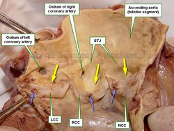 Aortic root of the ascending aorta open by dissection