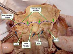 Aortic root of the ascending aorta open by dissection