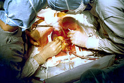 Cardiovascular bypass surgery (www.wikipedia.com)