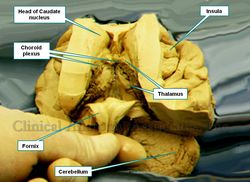Brain dissection showing the thalamus