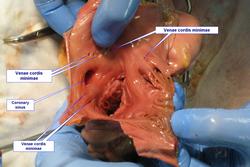 Human heart - open right atrium